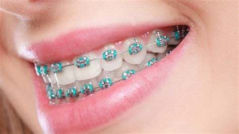 what is omni metal dental brackets|orthodontic brackets japan.